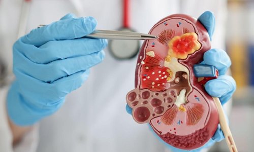 Pediatric Kidney Stones Treatment in Nagpur