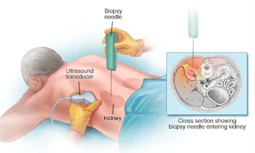 Pediatric Renal Biopsy in Nagpur